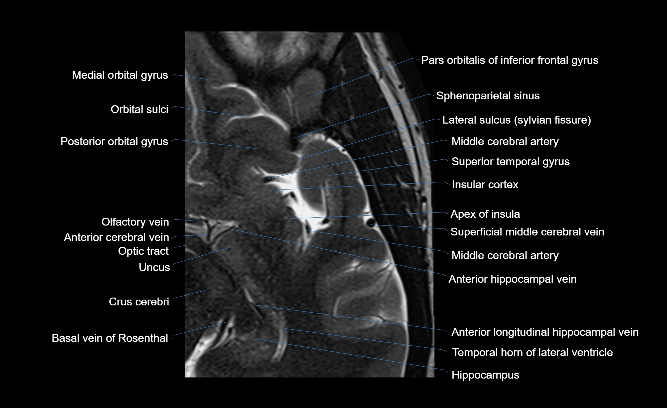 Brain insula axial  anatomy 3T MRI image-img-00001-00004.webp